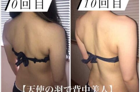 ビキニを着た女性が治療前と治療後の背中を見せている。