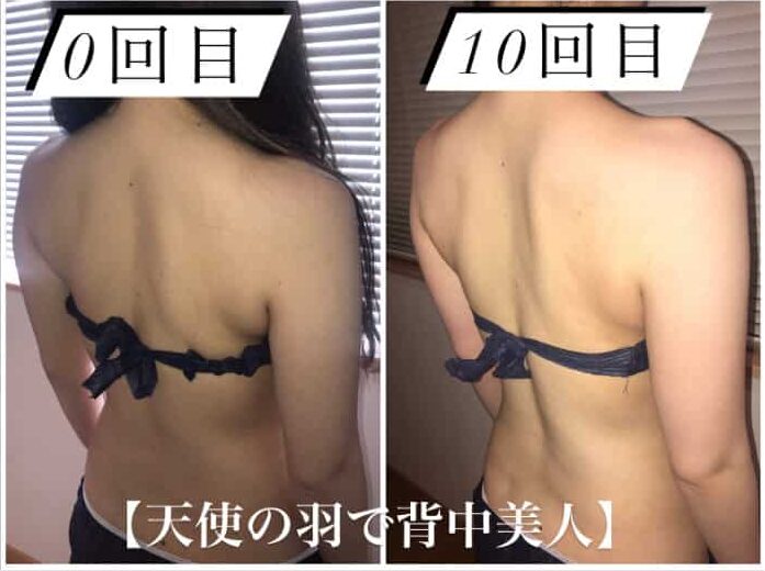 ビキニを着た女性が治療前と治療後の背中を見せている。